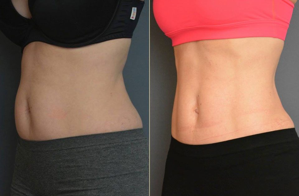 Lisa – CoolSculpting
