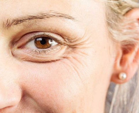 Brow Lift