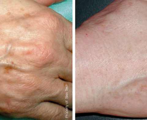 Hand Rejuvenation