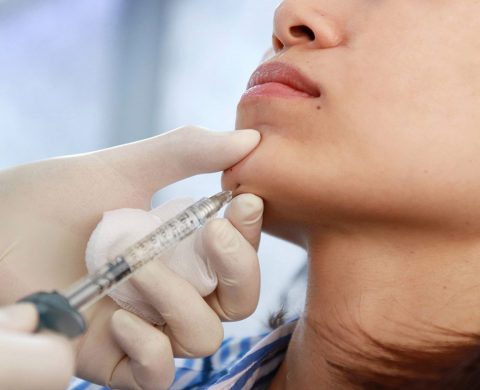 Chin Augmentation