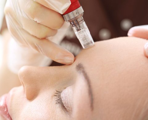 Microneedling
