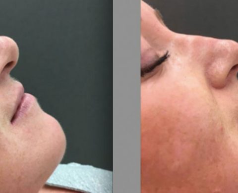 Non Surgical Rhinoplasty