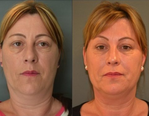 Dermal Fillers