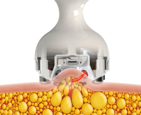 Skin Tightening (Face)