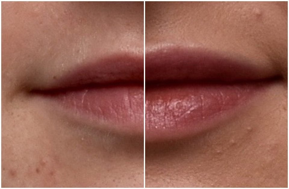 Amy’s Story – Lip Fillers