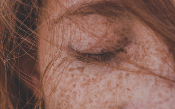 What causes Pigmentation and how to manage it effectively