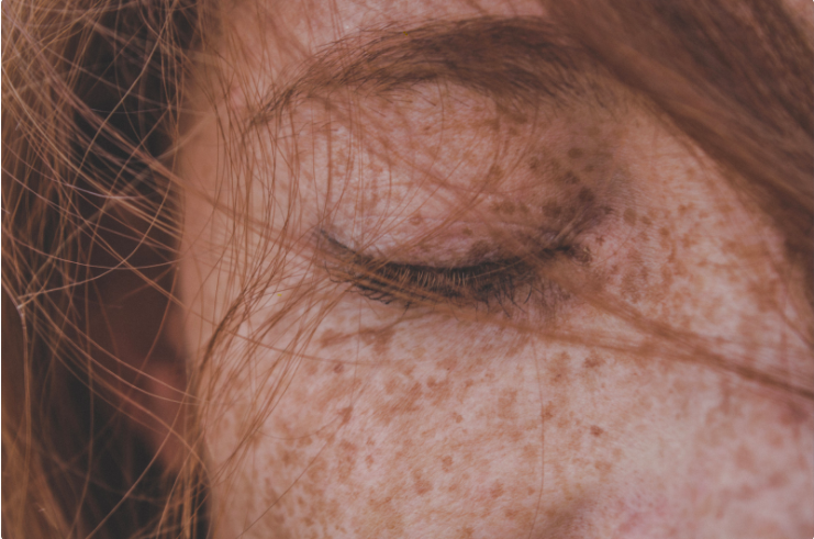 What causes Pigmentation and how to manage it effectively