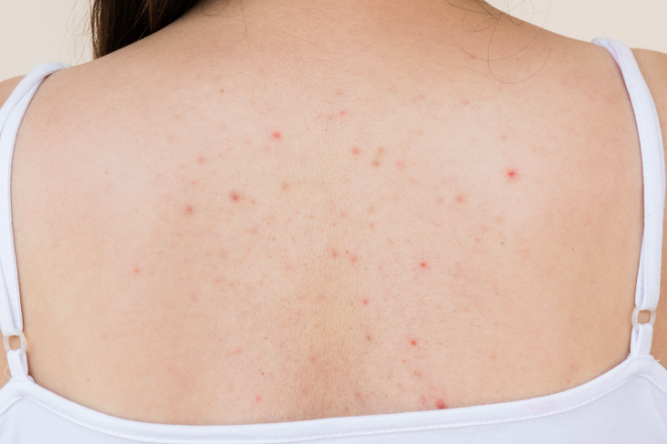 7 ways to combat back acne