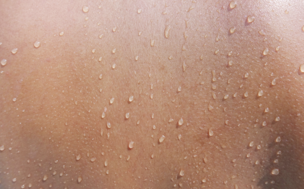 How Can I Prevent Excessive Sweating?