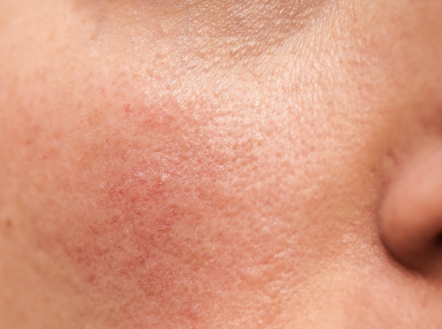 How To Manage and Treat Rosacea effectively