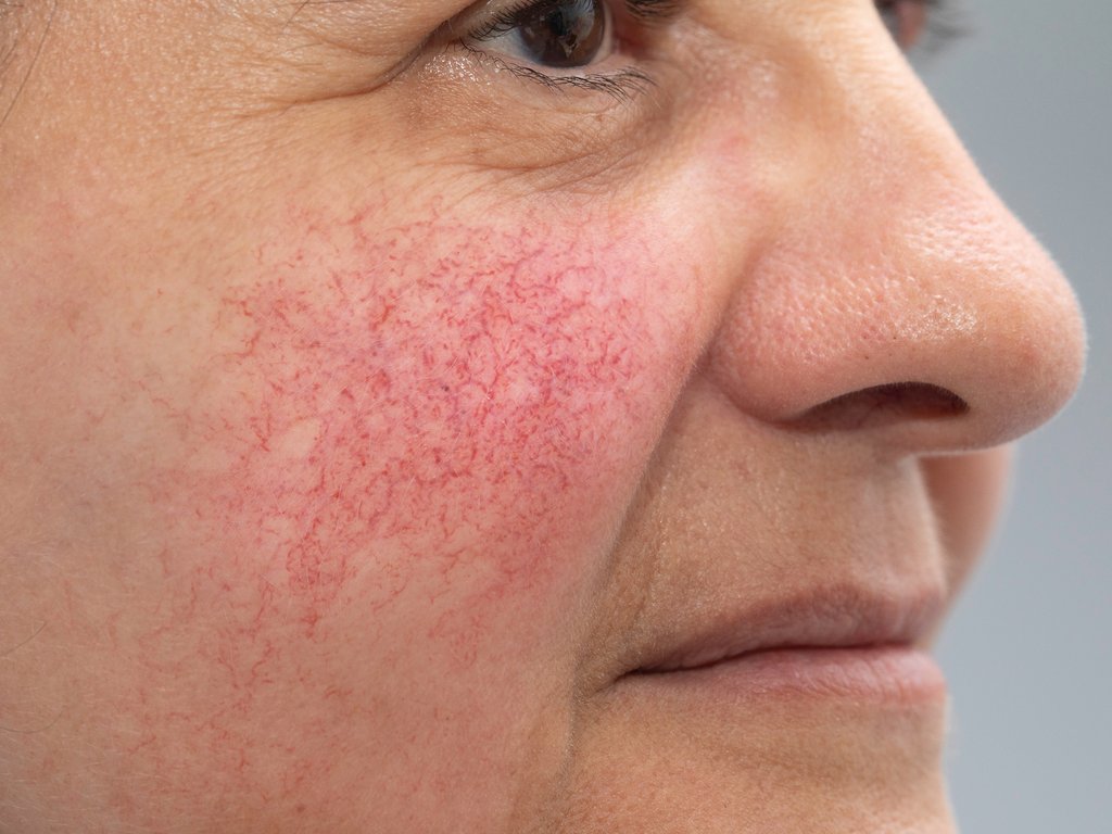 Have I got Rosacea or is my skin just red?