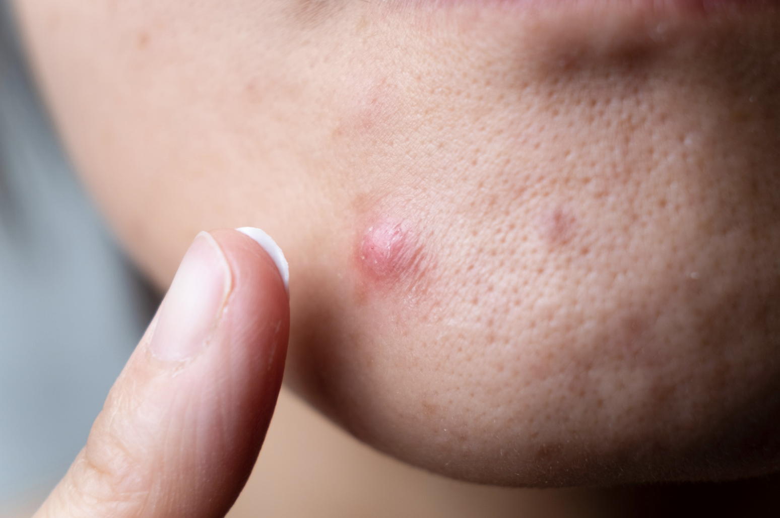 5 things to try before going to your GP about your acne