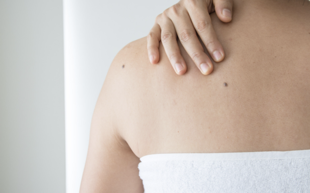 How much does it cost to remove a mole?
