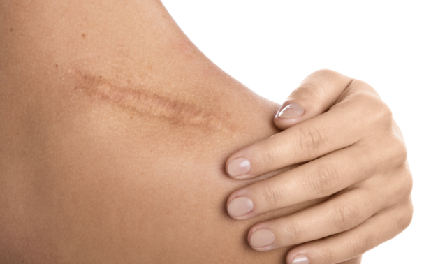 How to reduce the appearance of scars