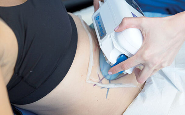 CoolSculpting vs. EmSculpt: Which is right for me?
