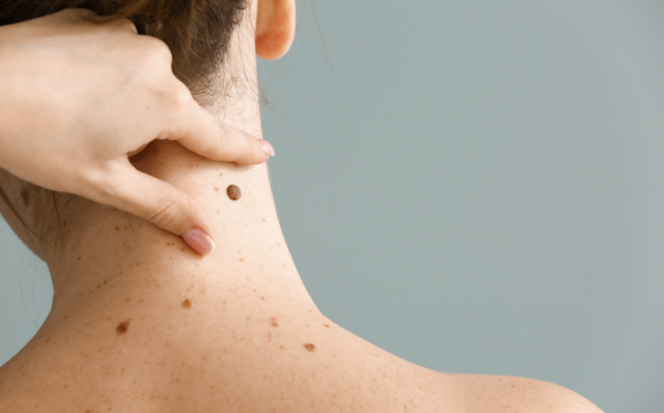 What does a cancerous mole look like?
