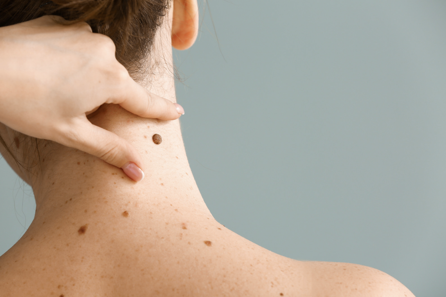 What does a cancerous mole look like?
