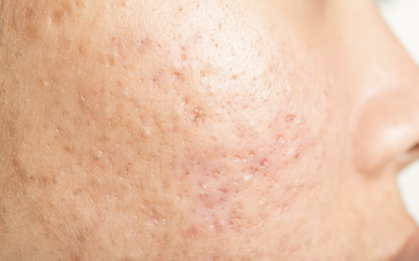 Are acne scars permanent? And can they be removed?