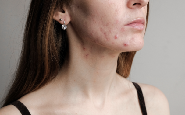 How do you know if your acne is hormonal?