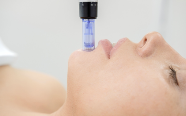 What is microneedling? And does it help reduce acne breakouts?