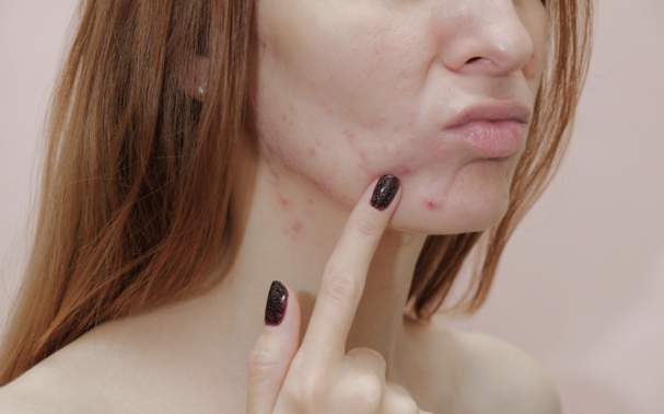 What kind of acne do you have? And what is the best way to treat it?