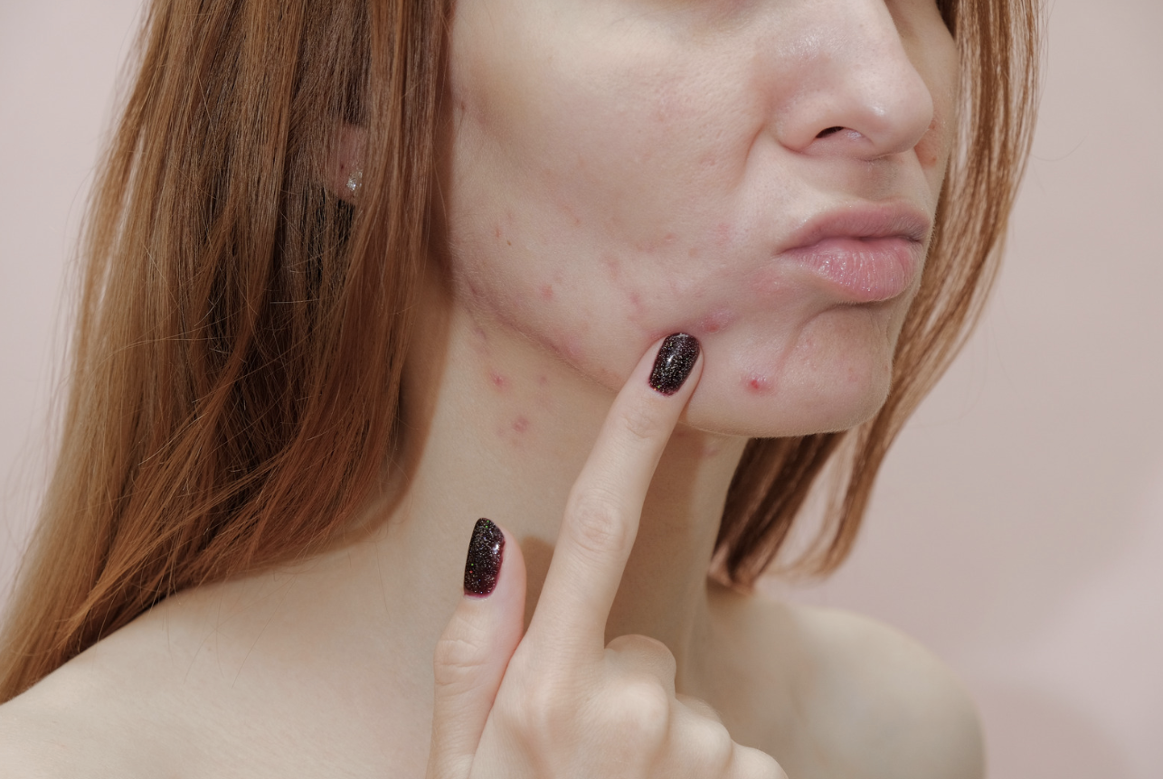 What kind of acne do you have? And what is the best way to treat it?