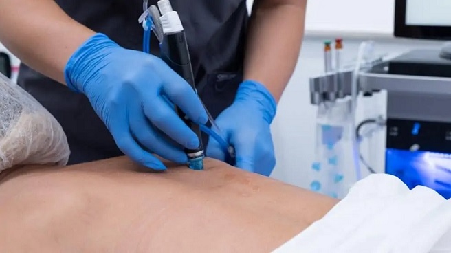 Is HydraFacial good for back acne?