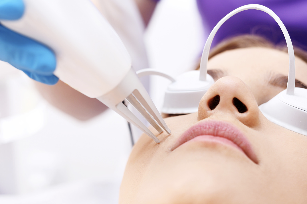 Radiofrequency vs Laser Skin Tightening – Which is right for me?