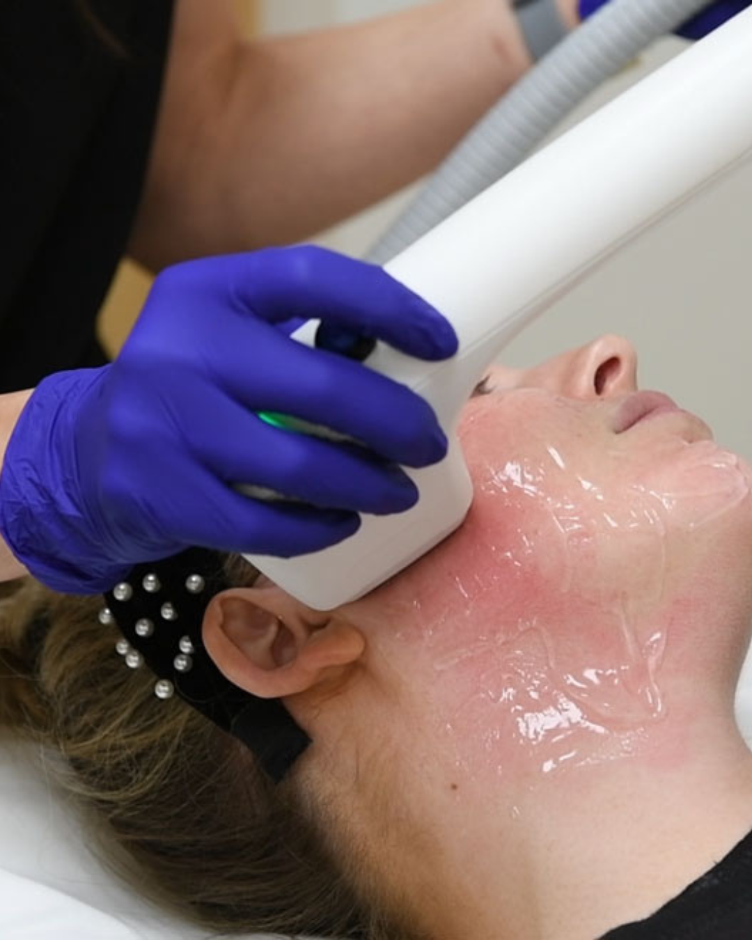 Sofwave Non-Surgical Skin Tightening – Is It Worth It?