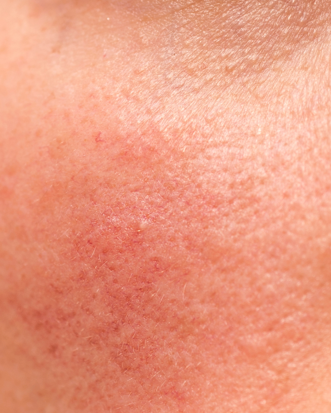 The top causes of skin redness and how to treat it