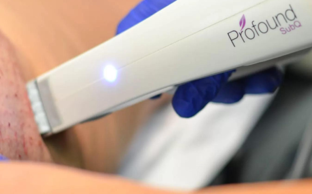 Does Profound RF melt fat?