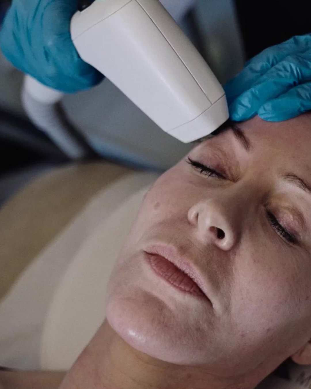 How Long Does Sofwave Last? And When Will I See Results?