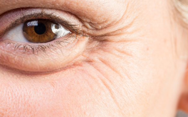 Can crow’s feet be reversed?