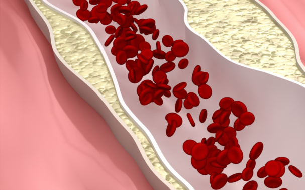 Five Easy Ways to Lower Your Cholesterol Levels