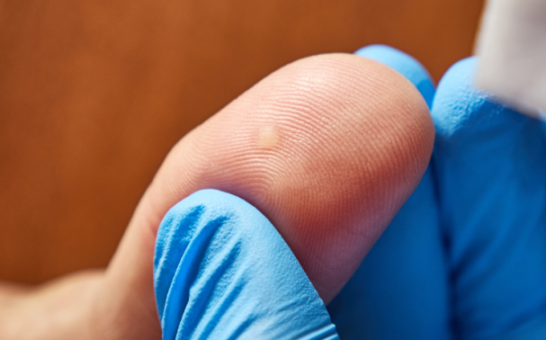 How to remove a wart without scarring