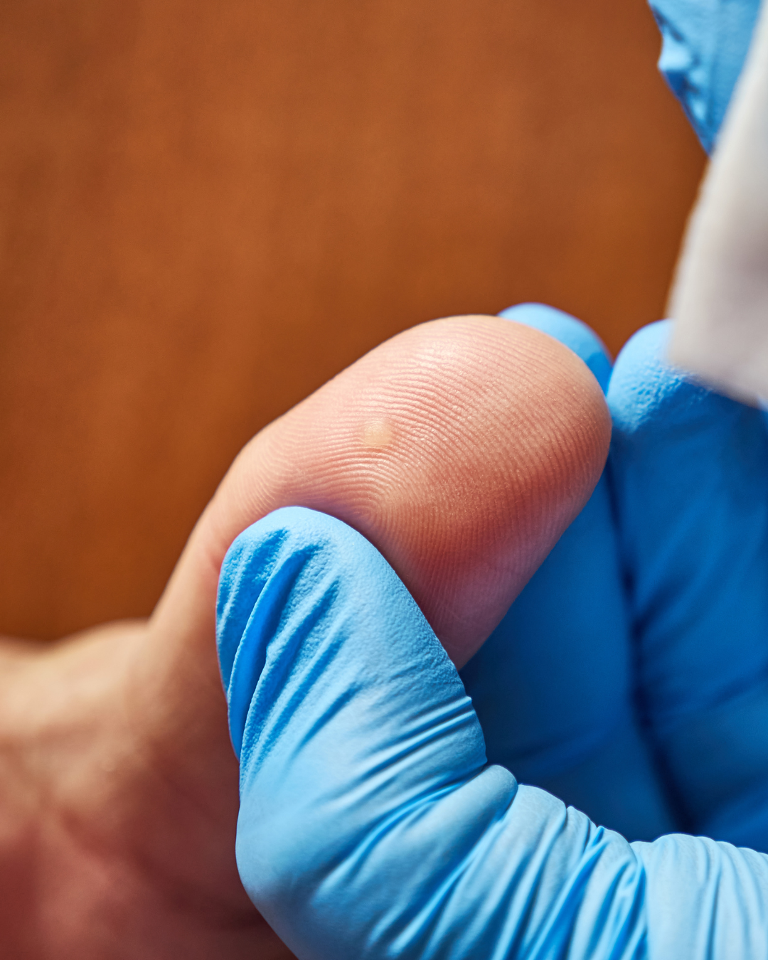 How to remove a wart without scarring
