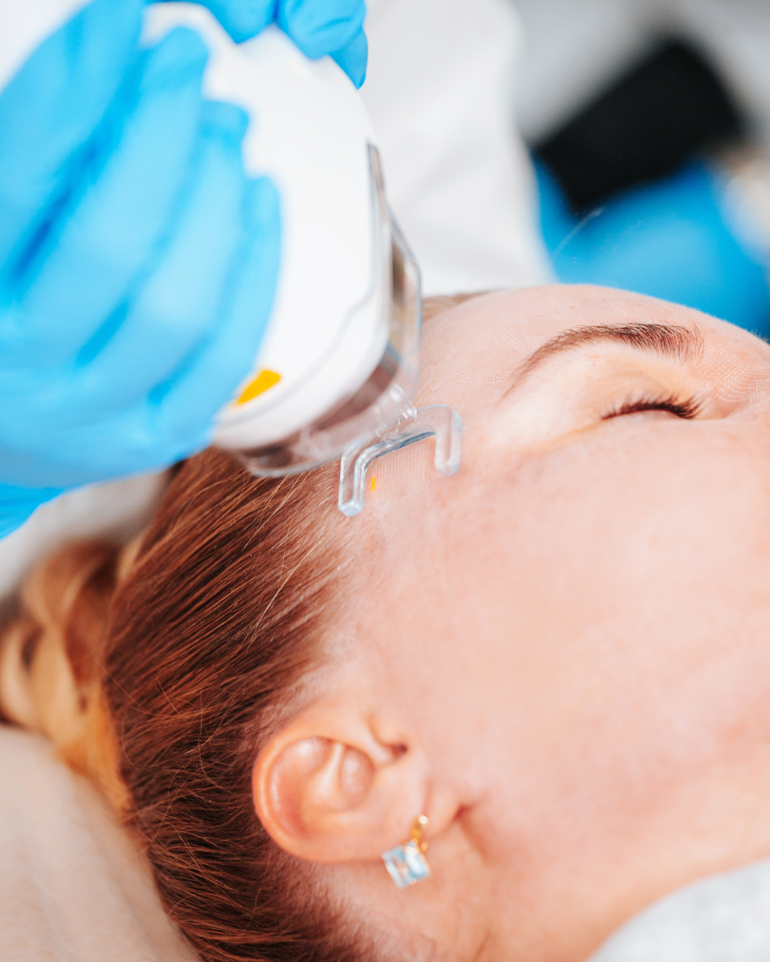 Can Laser Skin Resurfacing Cause Skin Cancer?